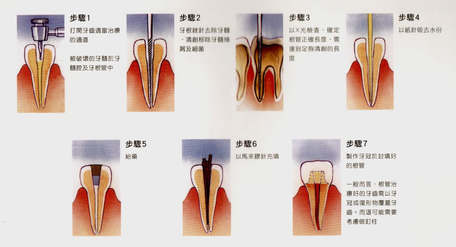 根管治疗 根管治疗是牙髓病和根尖周病的国际上最常用的有效治疗方法
